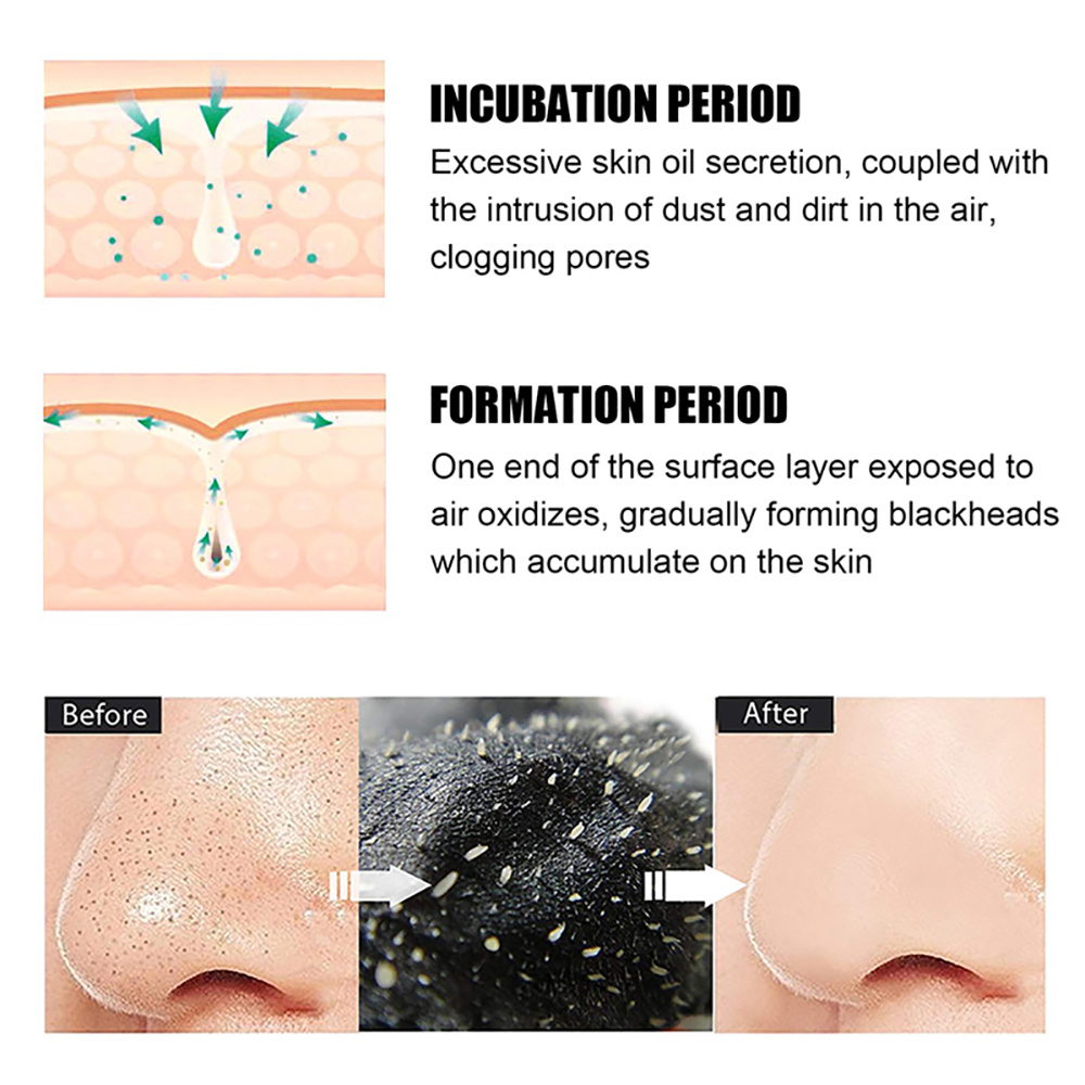 Blackhead Remover Nasal Strips - Nasal Aspirator recension och pris